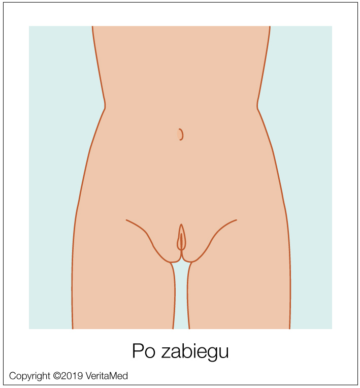 Labioplastyka - PO ZABIEGU - VeritaMed.jpg